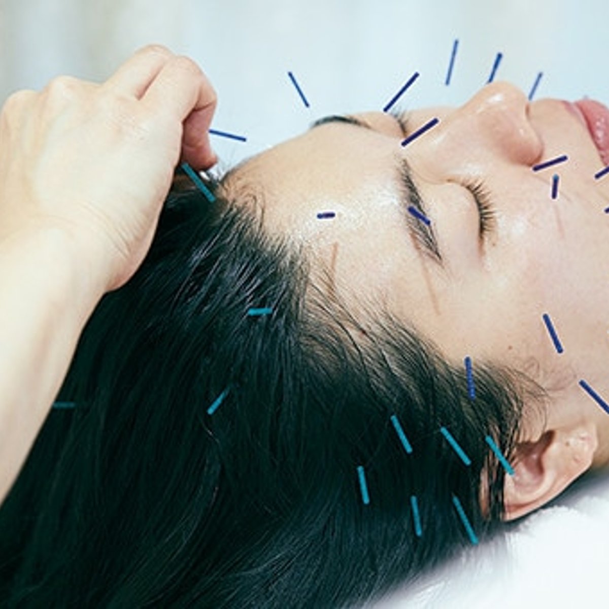 【3万円前後でキレイの投資】美容鍼で顔の歪みを整えたい。