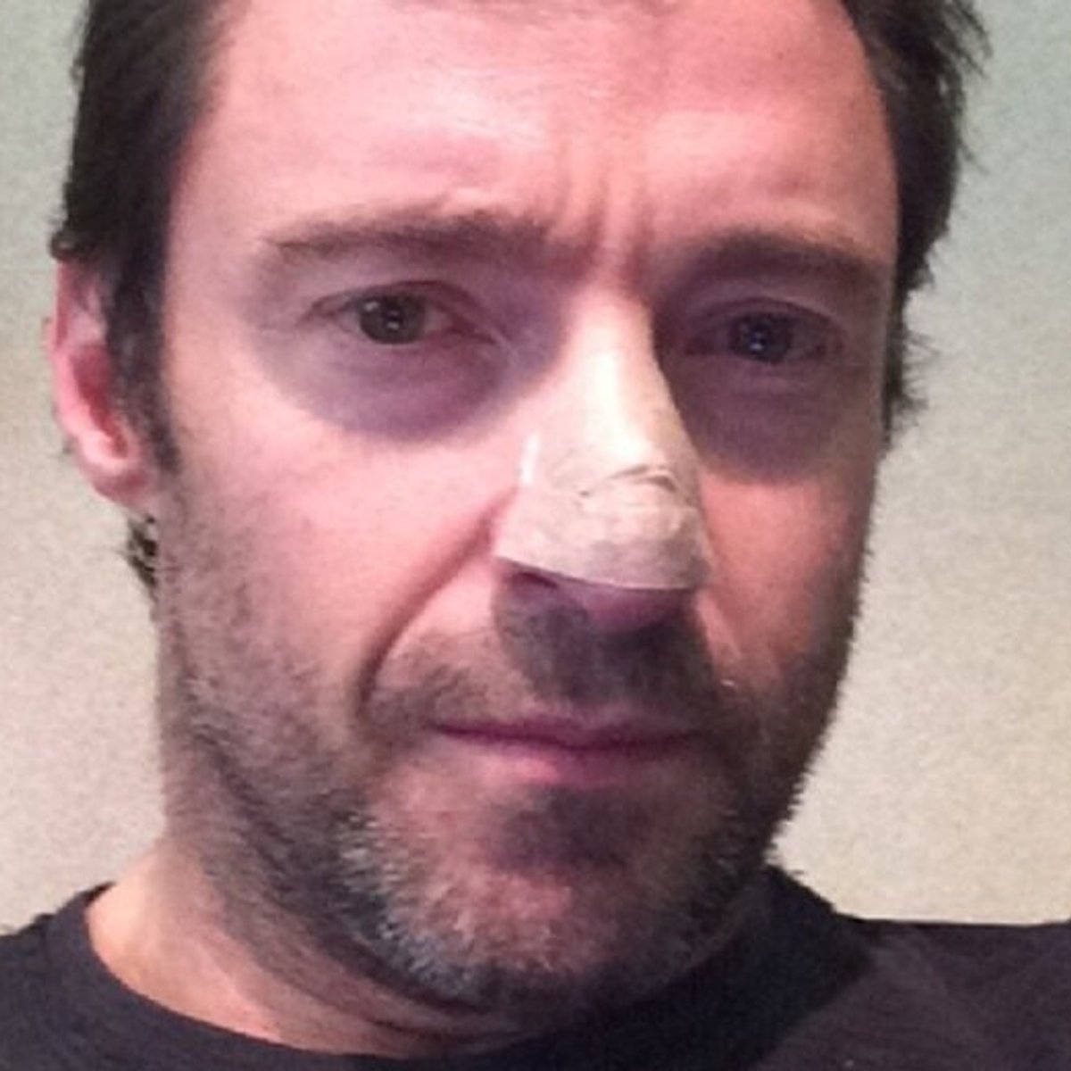 ヒュー・ジャックマン、自身の皮膚がんについて語る。