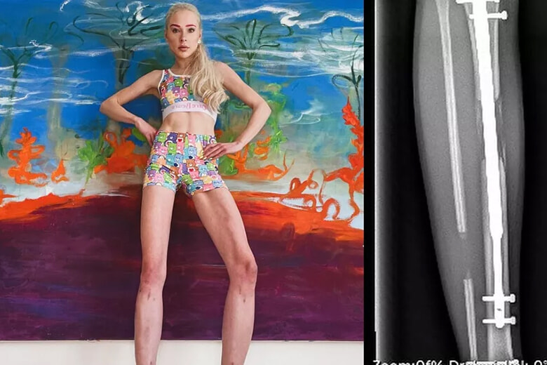 手術で身長を14cm伸ばしたモデル、その理由に批判の嵐。